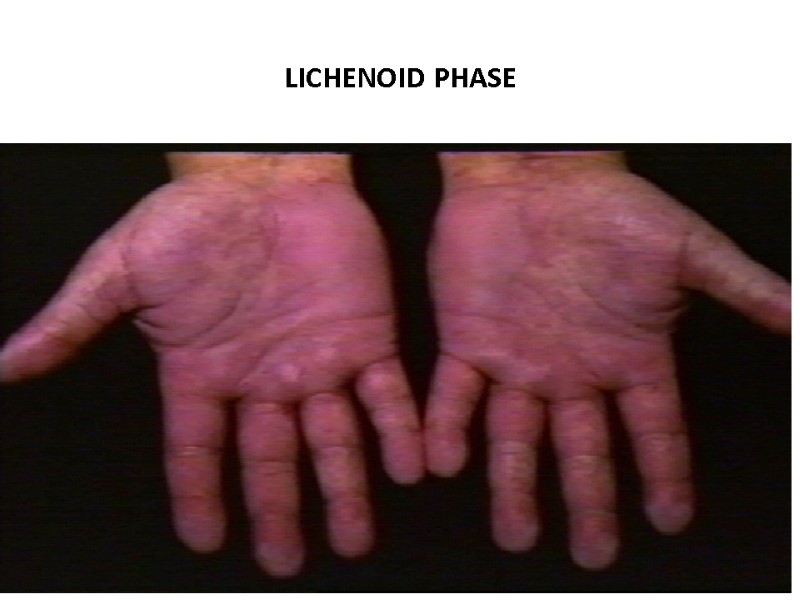 LICHENOID PHASE